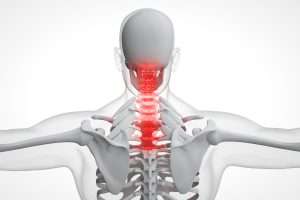 Misalignment Of Cervical Spine Symptoms and Treatment Options