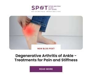 Arthritis of Ankle