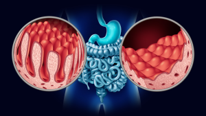 What Is a Neurolytic Celiac Plexus Block, and Who Needs It