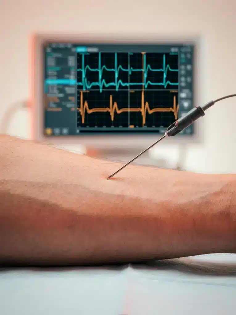 Close-up of an EMG diagnostic tool being used on a patient's forearm to accurately map nerve activity and identify pain sources