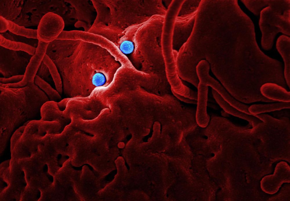 Medical illustration of sickle-shaped red blood cells associated with chronic pain