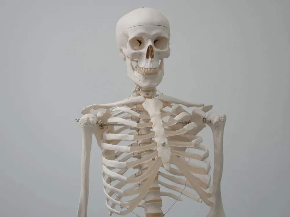 Anatomical model showing lumbar spinal stenosis nerve compression in the spine