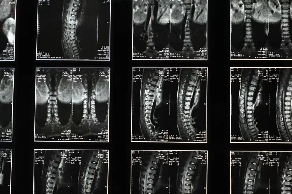 Facet Joint Injection in Tyler, TX | Non-Surgical Back Pain Care 1 Anatomical model of lumbar spine showing facet joints involved in back pain