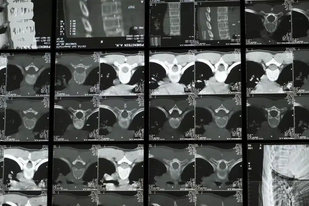 Intrathecal Pain Pump in Plano, TX | Same-Week Consults 2 Anatomical spine model showing intrathecal space relevant to pain pump placement