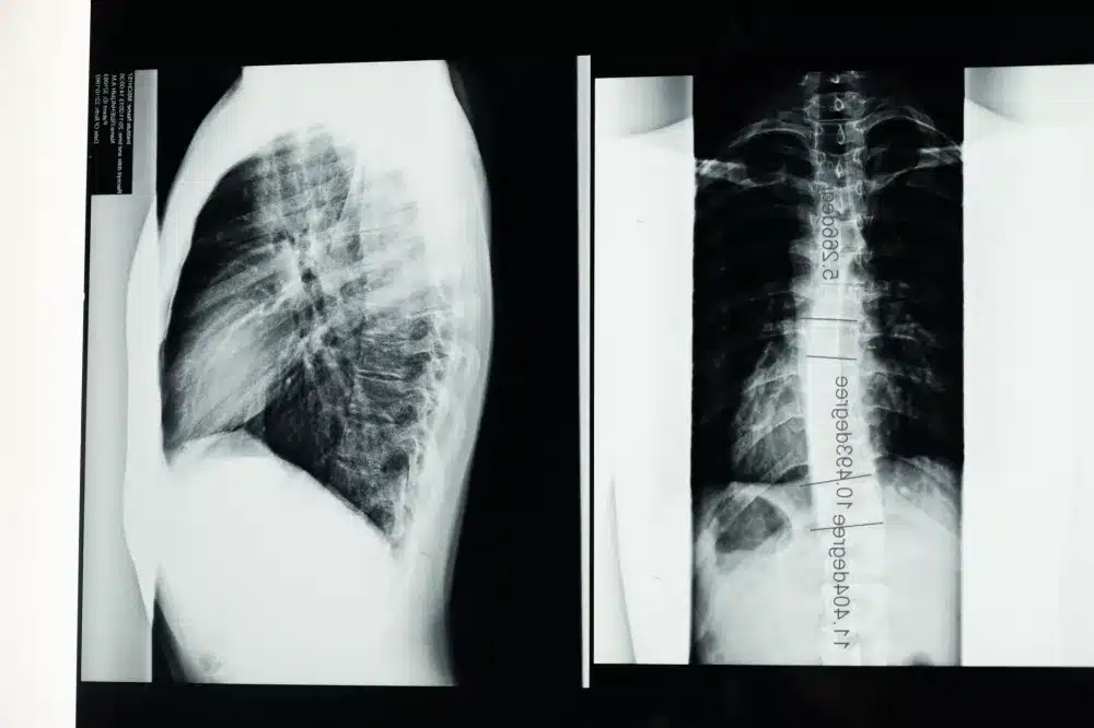 Anatomical spine model showing lumbar vertebrae and nerve roots relevant to back pain